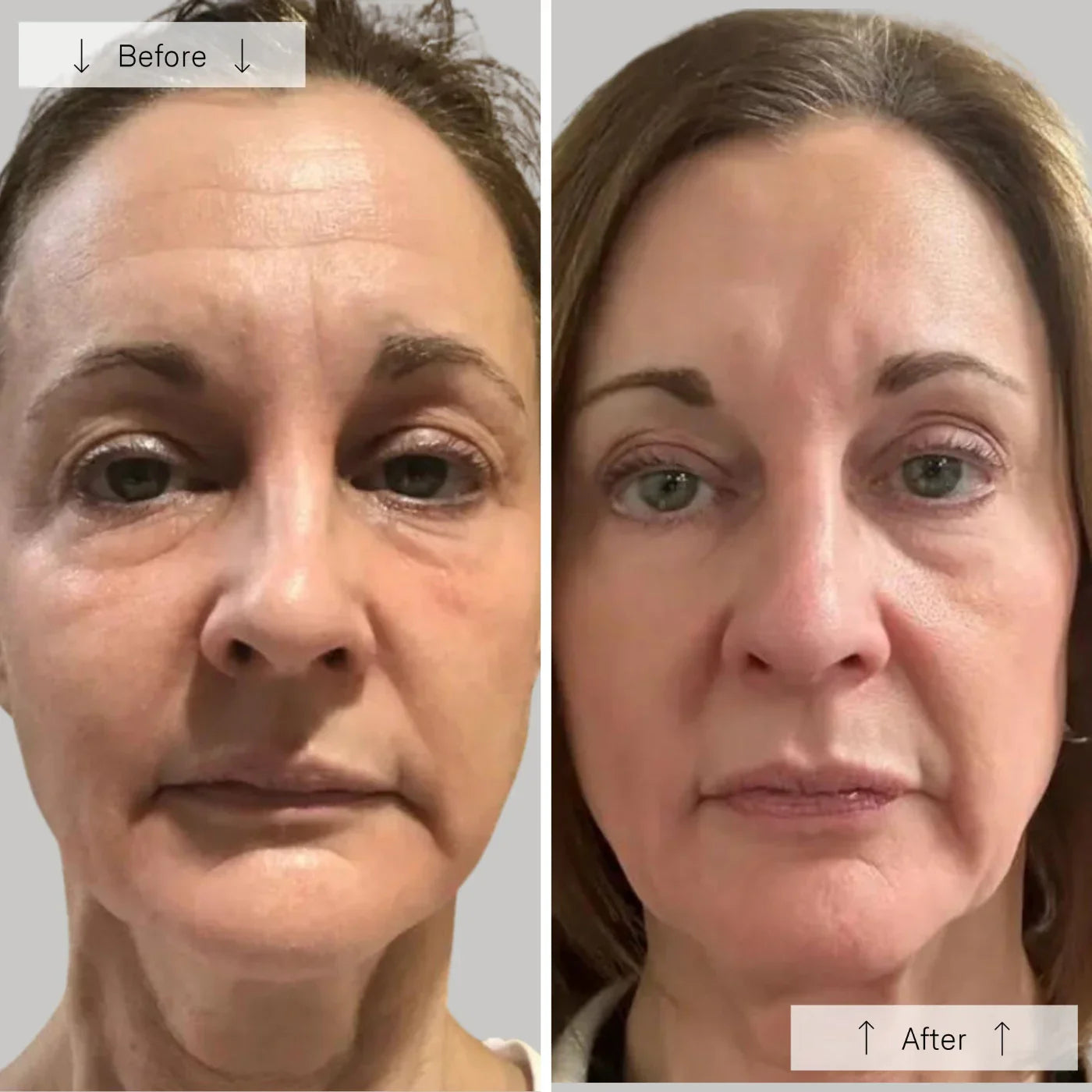 Yuna - Omnilux LED maska proti stárnutí